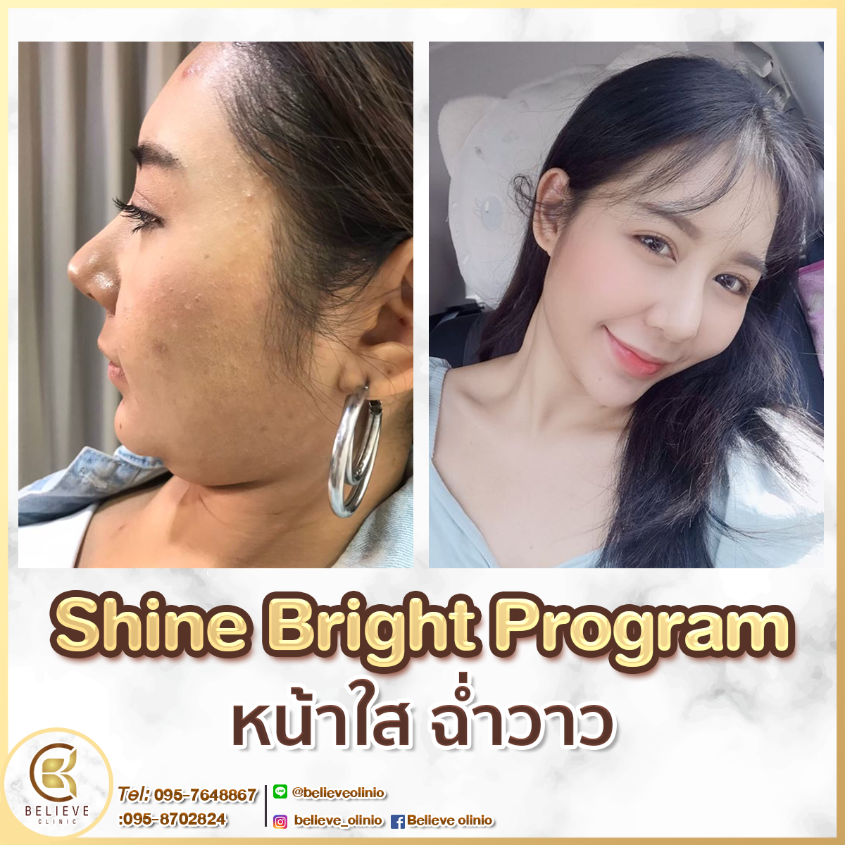 Shine Bright Program ฉีดหน้าใส ฉ่ำวาวสไตล์สาวเกาหลี - Believe Clinic