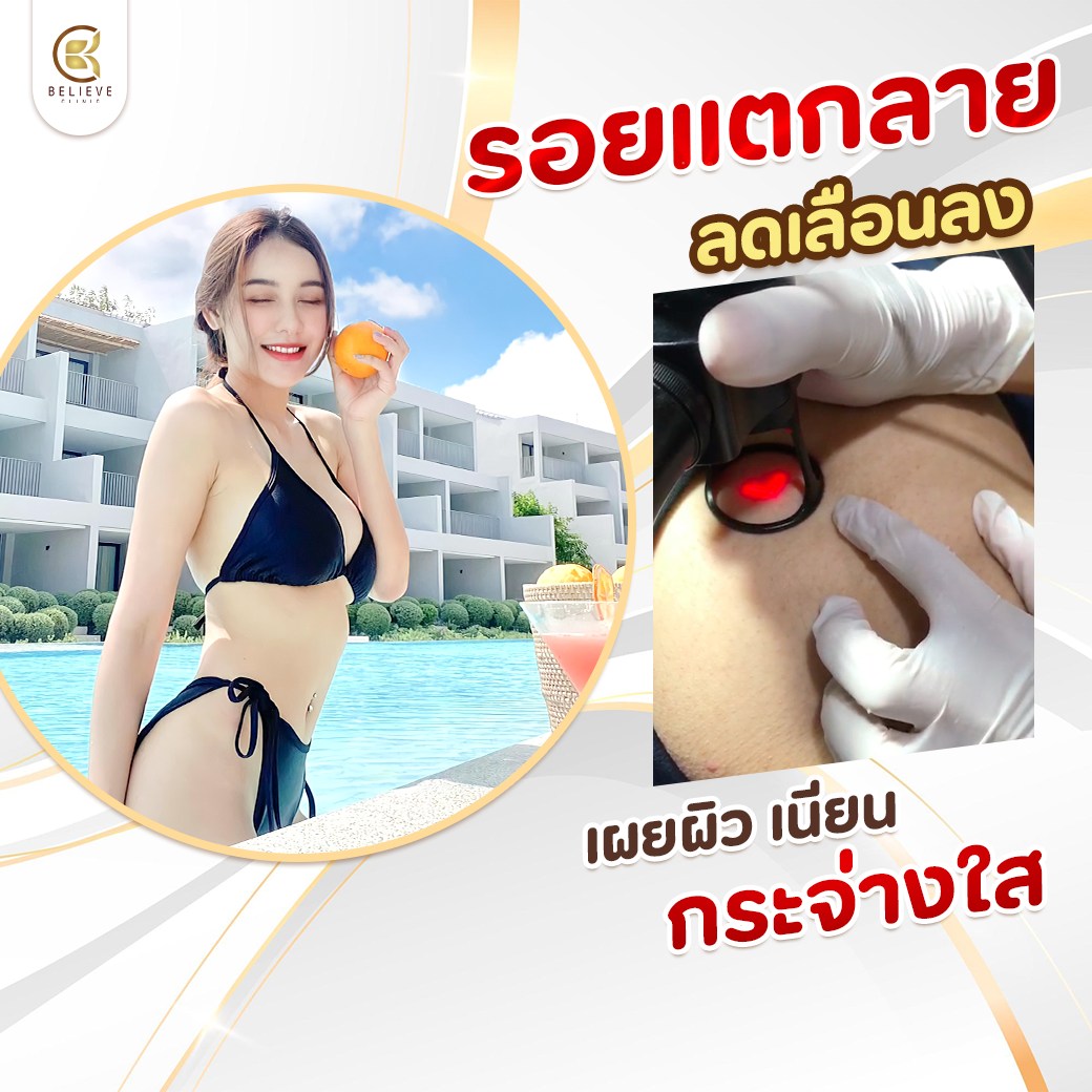 โปรโมชั่นรักษารอยแตกลาย