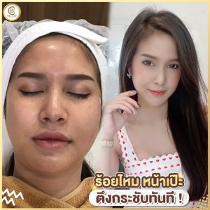 รีวิวร้อยไหม