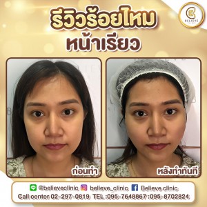 คลินิกร้อยไหม ไม่เจ็บ