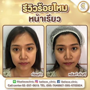 คลินิกร้อยไหม ไม่เจ็บ