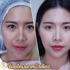 review ร้อยไหม