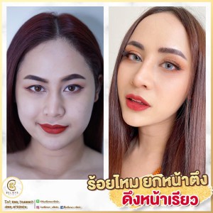 ร้อยไหมที่ไหนดี