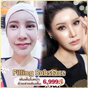 เติมเต็มร่องเเก้ม เสริมโหงวเฮ้ง