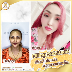 ฉีดฟิลเลอร์ที่ไหนดี