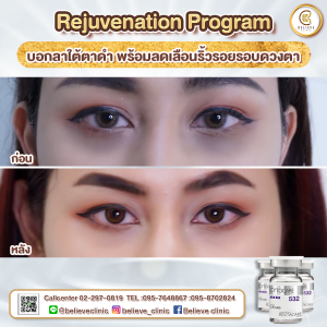 รักษาใต้ตาดำ