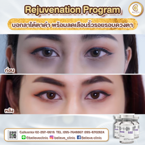 รักษาใต้ตาดำ