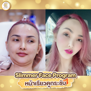 โปรโมชั่น meso fat