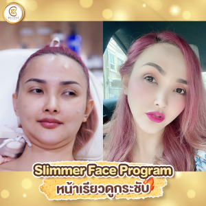 โปรโมชั่น meso fat