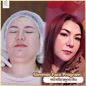 meso fat ยาแท้