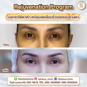 ฉีดลดใต้ตาดำ