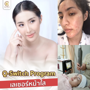 Q-Switch เลเซอร์รอยดำ