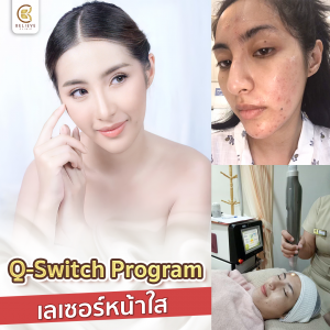 Q-Switch เลเซอร์รอยดำ