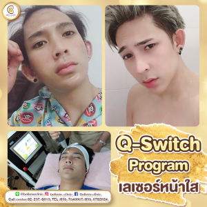 ยิงเลเซอร์รักษารอยสิว