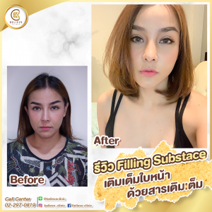 review ฟิลเลอร์